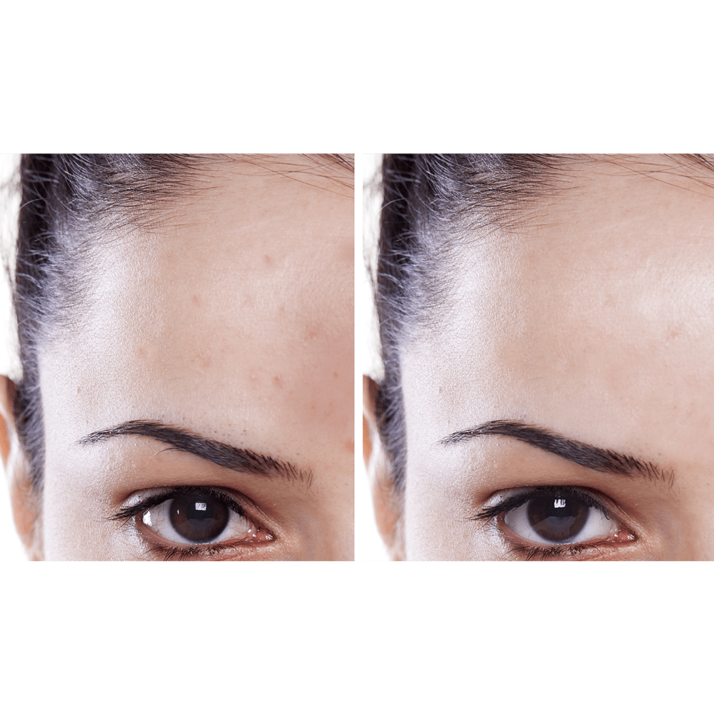 5-aqua-glo-hydradermabrasion