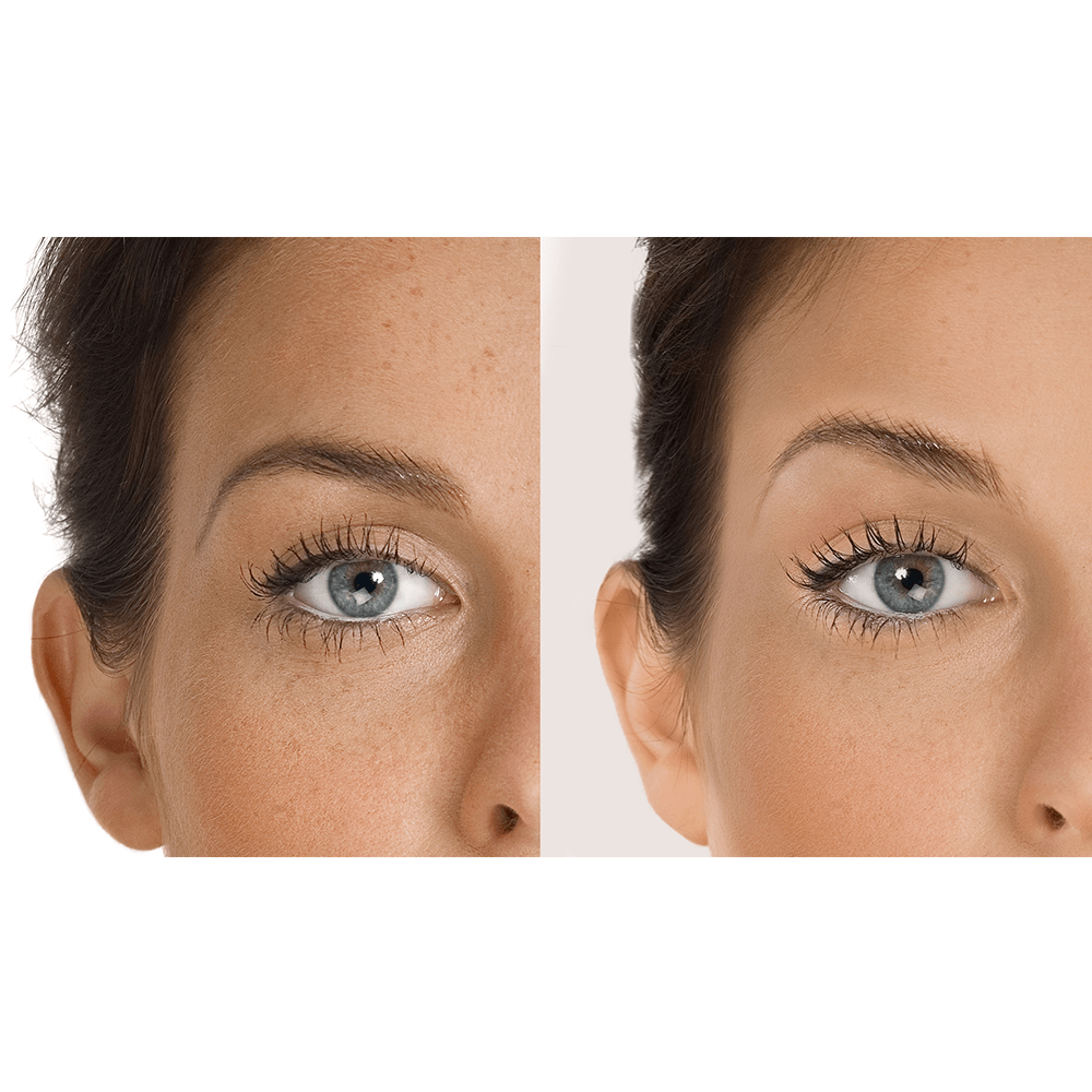 6-aqua-glo-hydradermabrasion